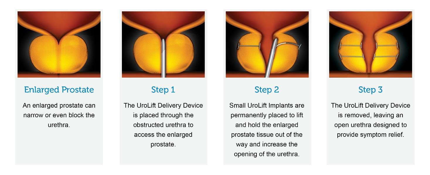images showing BPH The UroLift System.  consists of a delivery device and tiny permanent implants. picture 1 The UroLift Delivery Device is placed through the obstructed urethra. Picture 2 Small UroLift Implants are placed to lift or hold the enlarged prostate tissue out of the way.  Picture 3 The UroLift Delivery Device is removed, leaving an open urethra that provides symptom relief.