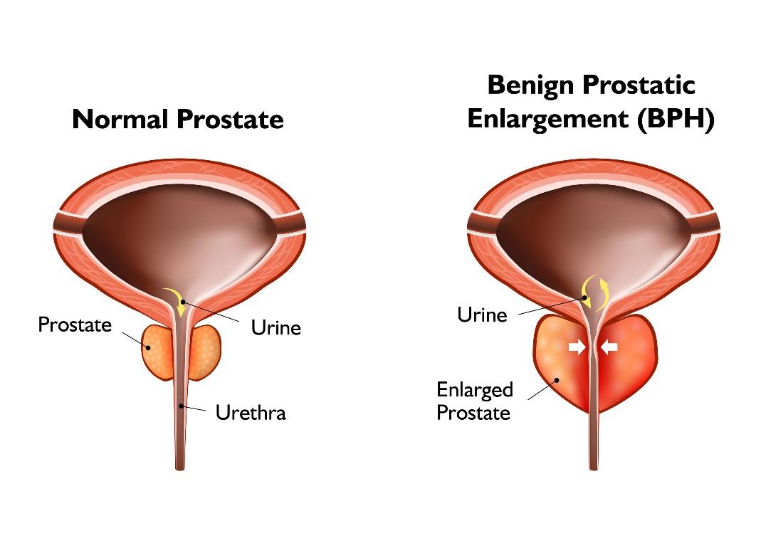 Images showing a normal prostate and a prostate with BPH - Benign Prostatic Enlargement