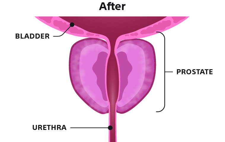 Rezūm Water Vapor Therapy After Illustration