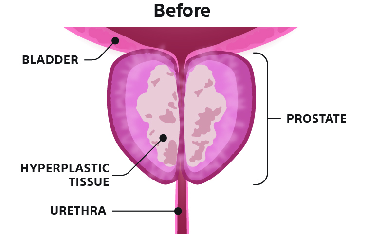 Rezūm Water Vapor Therapy Before Illustration