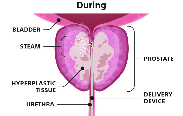 Rezūm Water Vapor Therapy During Illustration