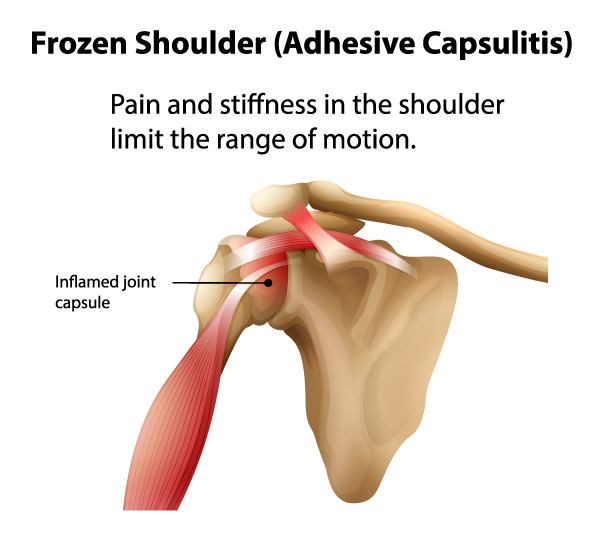 Frozen shoulder (adhesive capsulitis)